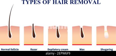 Follicule normal et les types d'épilation à l'aide de rasoir, crème d'épilation, cire, illustration de vecteur sugaring Illustration de Vecteur