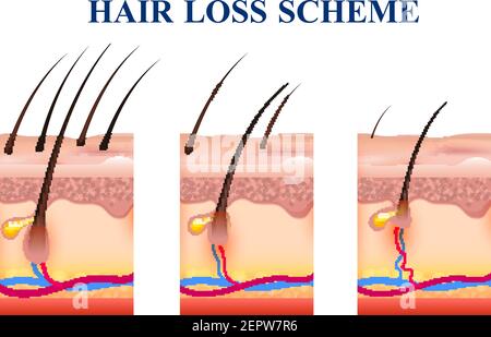 Étapes de la perte de cheveux sur la peau humaine, schéma avec la structure anatomique incluant les follicules, les veines, les nerfs, illustration vectorielle Illustration de Vecteur