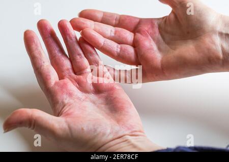 Dermatite atopique, rouge, démangeaisons des mains avec cloques et peau gercée. Banque D'Images