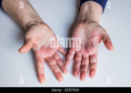 Dermatite atopique, rouge, démangeaisons des mains avec cloques et ...