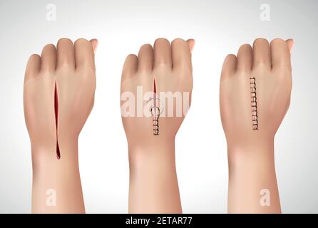 La suture chirurgicale permet de coudre une composition réaliste avec des images isolées de l'homme main à différentes étapes de l'assemblage de l'illustration vectorielle Illustration de Vecteur