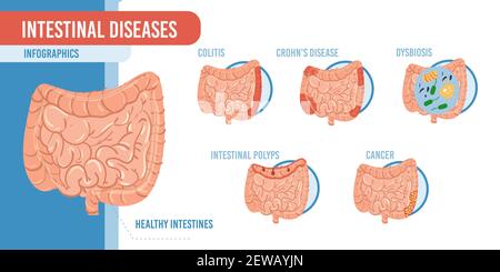 Dessin animé plat infographie maladies intestinales vecteur illustration concept Illustration de Vecteur