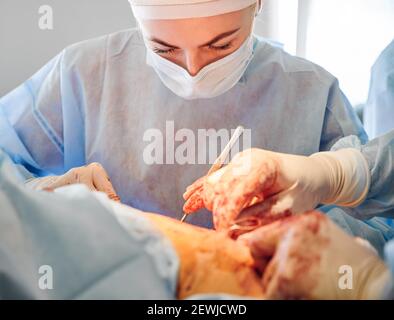 Femme chirurgien dans un masque médical effectuant une opération chirurgicale plasmique dans la salle d'opération de l'hôpital. Jeune femme médecin en chirurgie plastique abdominale. Concept de l'abdominoplastie et de la chirurgie esthétique Banque D'Images
