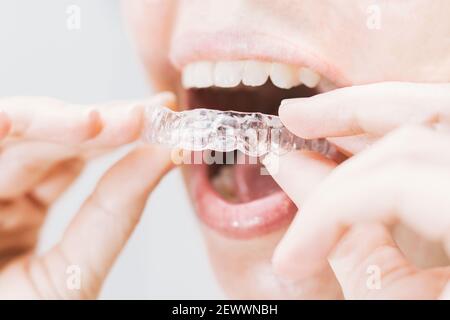 gros plan de la bouche de la femme en mettant sur un dispositif de retenue transparent avec éclairage naturel et doux Banque D'Images