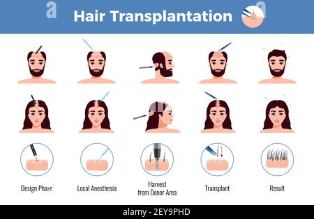 Transplantation de cheveux pour les hommes et les femmes avec des étapes d'opération infographies sur illustration vectorielle d'arrière-plan blanc Illustration de Vecteur