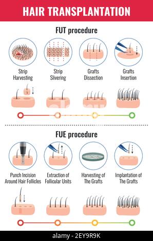 Méthodes de la transplantation de cheveux avec les étapes de la procédure infographiques sur illustration vectorielle sur fond blanc Illustration de Vecteur