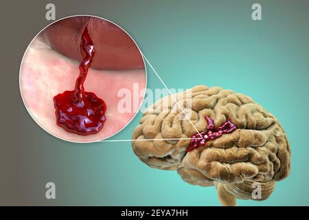 AVC hémorragique, illustration Banque D'Images