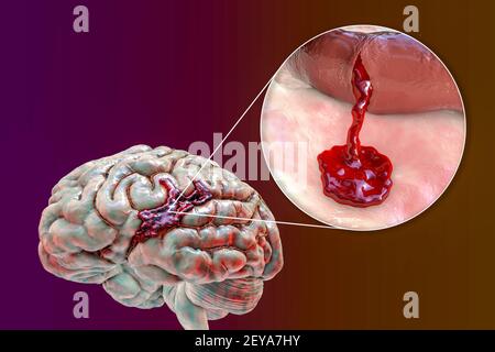 AVC hémorragique, illustration Banque D'Images