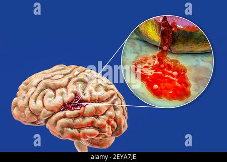 AVC hémorragique, illustration Banque D'Images