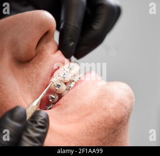 Gros plan des mains orthodontistes en plaçant un élastique en caoutchouc sur les supports patient. Jeune homme avec des bretelles métalliques filaires sur les dents recevant un traitement orthodontique en clinique dentaire. Concept de la dentisterie. Banque D'Images