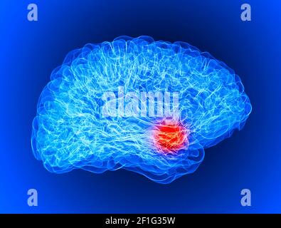 Douleur dans la tête, le cerveau et les synapses, problèmes cognitifs, déficit mental. Anévrisme. Maladies dégénératives affectant la région du cerveau. Parkinson, accident vasculaire cérébral Banque D'Images