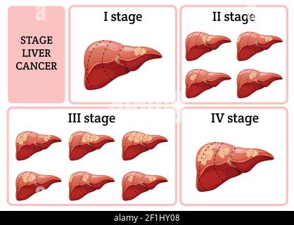 Cartoon interne de la maladie d'organe humain concept avec quatre étapes de illustration du vecteur du cancer du foie Illustration de Vecteur