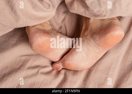 talon dans les fissures des frottis sur les jambes la femme fissure talons dermatite de maladie blanche, podiatre callosité. Eczéma appliquer dermatologue, défaut Banque D'Images