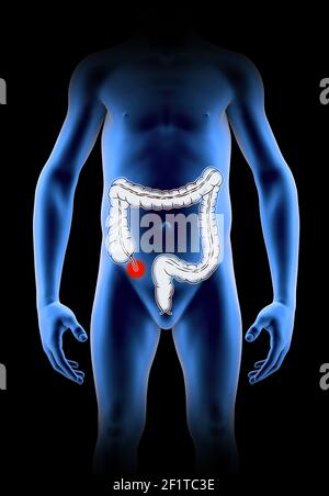 L'annexe est un tube à bout aveugle, à l'instar des doigts, relié au caecum. Le caecum est une structure semblable à une poche du côlon. rendu 3d. Appendicite Banque D'Images