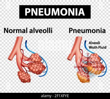 Schéma illustrant une pneumonie sur fond transparent Illustration de Vecteur