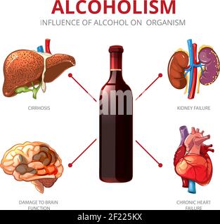 Effets à long terme de l'alcool. Fonction de l'organisme et lésions cérébrales, insuffisance illustration rénale. Infographie sur le vecteur de l'alcoolisme Illustration de Vecteur