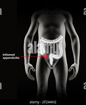 L'annexe est un tube à bout aveugle, à l'instar des doigts, relié au caecum. Le caecum est une structure semblable à une poche du côlon. rendu 3d. Appendicite Banque D'Images