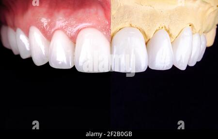 Sourire parfait avant et après les veneers javellisant de zircon Arch céramique prothèse implants couronnes. Clinique de traitement de restauration dentaire patient. Résultat de Banque D'Images