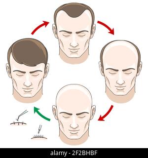 Les étapes de la perte de cheveux, le traitement des cheveux et la transplantation de cheveux. Perte de cheveux, chauve et soins, santé haor, croissance des cheveux humains, illustration vectorielle Illustration de Vecteur