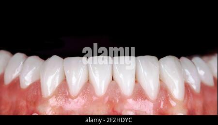 Sourire parfait avant et après les veneers javellisant de zircon Arch céramique prothèse implants couronnes. Clinique de traitement de restauration dentaire patient. Résultat de Banque D'Images