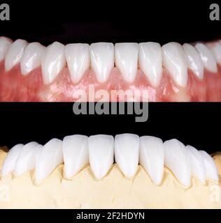 Sourire parfait avant et après les veneers javellisant de zircon Arch céramique prothèse implants couronnes. Clinique de traitement de restauration dentaire patient. Résultat de Banque D'Images