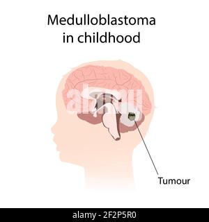 Médulloblastome dans l'enfance, illustration Banque D'Images