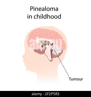 Pinealoma dans l'enfance, illustration Banque D'Images