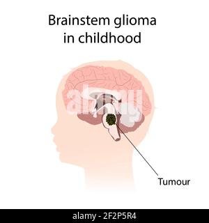 Gliome du tronc cérébral dans l'enfance, illustration Banque D'Images