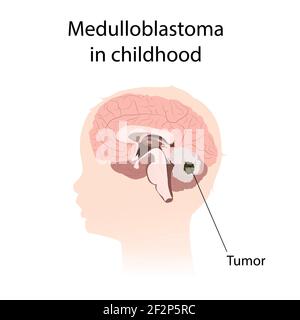 Médulloblastome dans l'enfance, illustration Banque D'Images