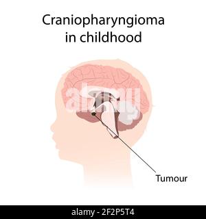 Craniopharyngioma dans l'enfance, illustration Banque D'Images