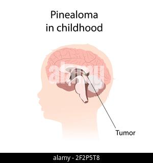 Pinealoma dans l'enfance, illustration Banque D'Images