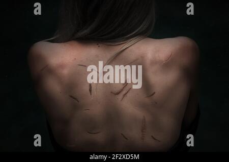 Gros plan sur le dos des femmes avec de nombreuses cicatrices il Banque D'Images