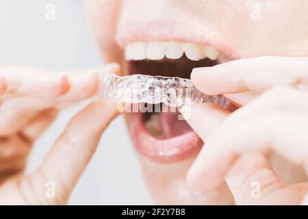 gros plan de la bouche de la femme en mettant sur un dispositif de retenue transparent avec éclairage naturel et doux Banque D'Images