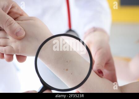 Le médecin examine la main avec des grains de beauté à travers la loupe Banque D'Images