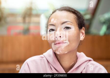 Noire africaine américaine femme avec vitiligo pigmentation problème de peau à l'intérieur vêtu rose sweat à capuche gros plan portrait pensif noir femme pensée à propos de Banque D'Images