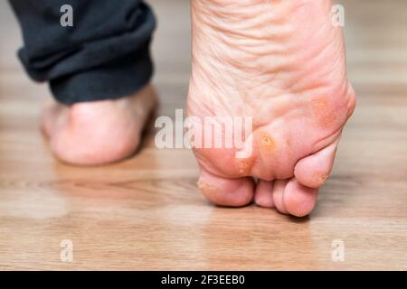 Pied avec cornes, callosités et peau sèche, verrucas plantaire verrucas verruques verruques. Virus du papillome de Verrucas, desase sur la peau du pied. Pied malsain avec du clo de maïs Banque D'Images