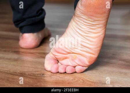 Pied avec cornes, callosités et peau sèche, verrucas plantaire verrucas verruques verruques. Virus du papillome de Verrucas, desase sur la peau du pied. Pied malsain avec du clo de maïs Banque D'Images