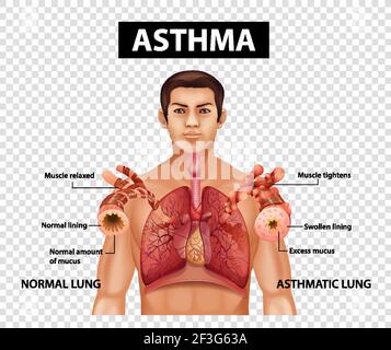Illustration de l'asthme sur fond transparent Illustration de Vecteur