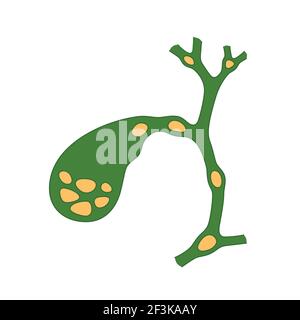 Variantes de l'emplacement des calculs dans la vésicule biliaire et les canaux biliaires. Schéma de la cholélithiase, maladie des calculs biliaires. Illustration de Vecteur