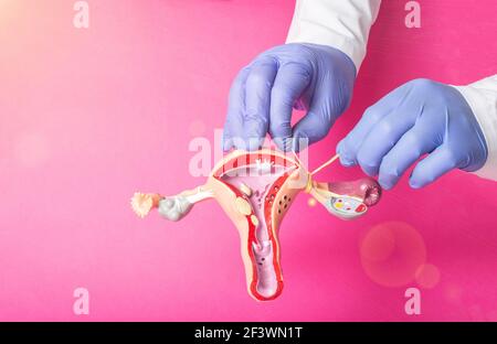 Le médecin gynécologue ligace les trompes de Fallope sur l'exemple de la disposition du système reproducteur féminin, fond rose. Concept de contraception Banque D'Images