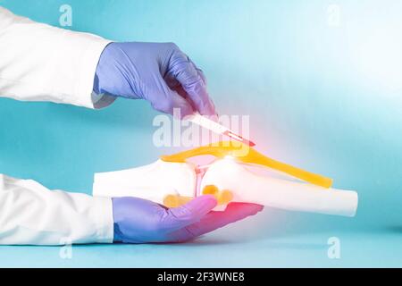 Le médecin-chirurgien tient un scalpel près de la maquette de l'articulation du genou sur un fond bleu. Le concept de chirurgie de remplacement articulaire, endoprothèse, arthroscopie Banque D'Images