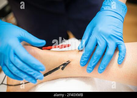 Électro-acupuncture sèche avec la machine de connexion d'aiguille. Électrostimulation en physiothérapie. Électro-acupuncture sèche avec la machine de connexion d'aiguille Banque D'Images