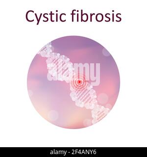 Fibrose kystique, illustration Banque D'Images