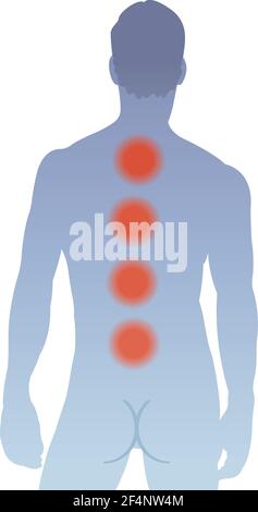 L'illustration montre les principales zones de douleur sur le dos de l'homme, causées par le myélome multiple. Illustration de Vecteur