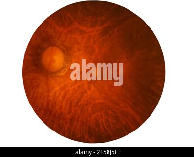 Rétine du diabète , diabètes rétinopathie,photo médicale Retina anormale isolée sur fond blanc.sauvegardée avec le chemin de coupure Banque D'Images