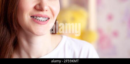 Le sourire d'une jeune fille avec des bretelles sur ses dents blanches. Redressage des dents. Banque D'Images