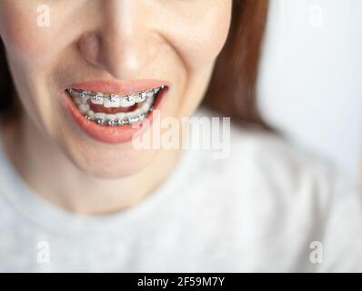 Le sourire d'une jeune fille avec des bretelles sur ses dents blanches. Redressage des dents. Banque D'Images