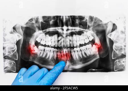 La main du médecin dans un gant médical de protection pointe avec un doigt vers une image radiologique de la courbure des dents inférieures sur un fond blanc. Banque D'Images