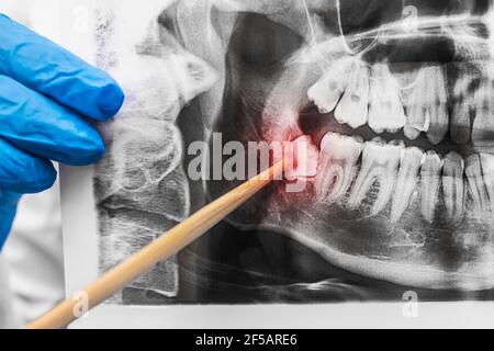 La main du dentiste dans un gant médical en caoutchouc tient une image de la bouche et pointe vers une dent de sagesse bien faite, gros plan. Banque D'Images
