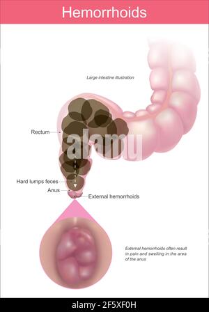 Hémorroïdes. Illustration expliquer la cause des hémorroïdes de votre anus. Infographie médicale sur la santé. Illustration de Vecteur